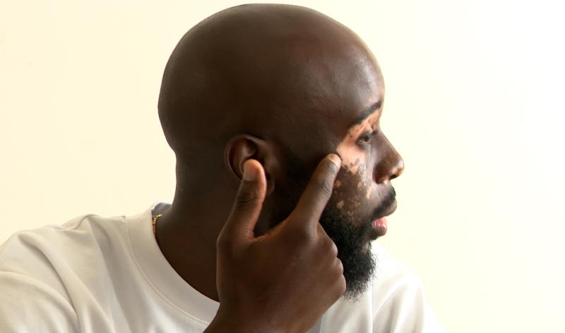 Vitiligo: apprendre à vivre avec le regard des autres