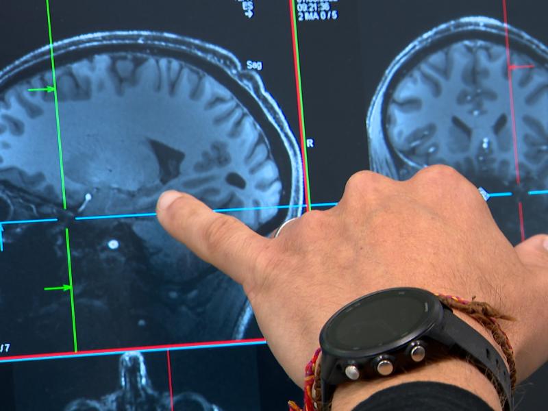Le sommeil et ses micro-réveils influencent la maladie d'alzheimer