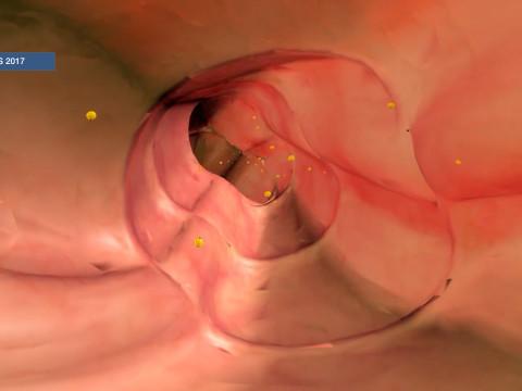 L'importance du dépistage du cancer colo-rectal !