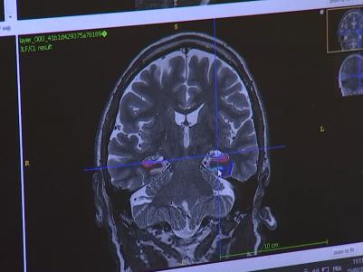 Les recherches de l'Université de Liège sur la maladie d'Alzheimer