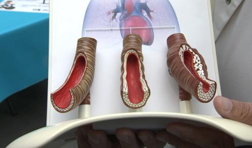 L'hypertension artérielle pulmonaire, une maladie invisible