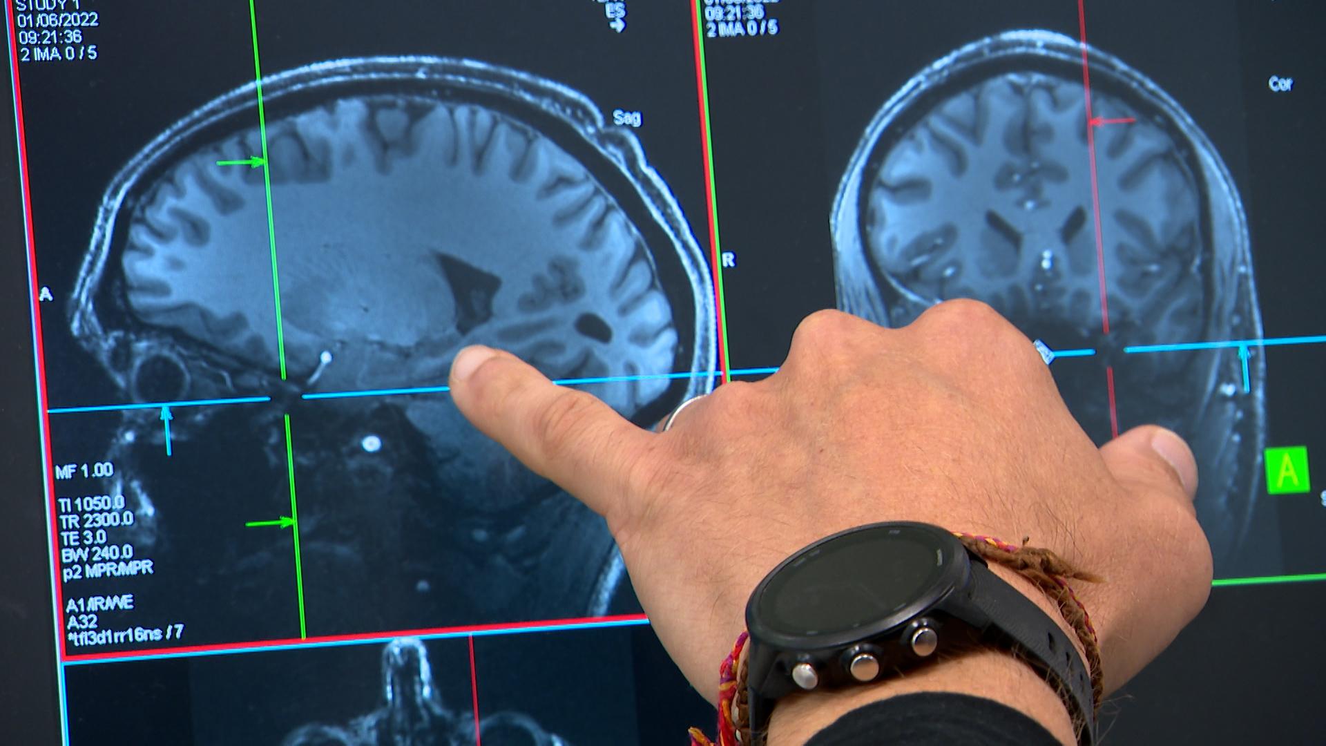 Le sommeil et ses micro-réveils influencent la maladie d'alzheimer