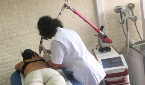 Se faire retirer un tatouage avec moins de douleurs et de frais