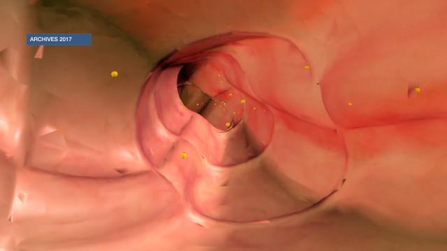 L'importance du dépistage du cancer colo-rectal !