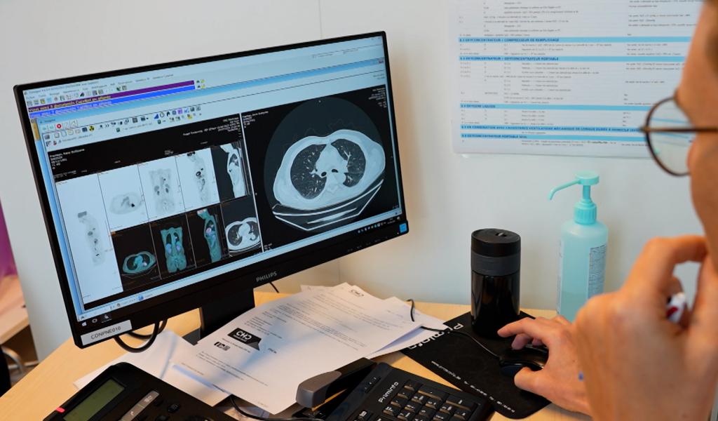 Cancer du poumon : + de femmes et + de non-fumeurs