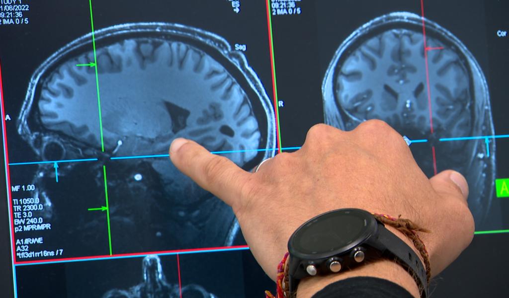 Le sommeil et ses micro-réveils influencent la maladie d'alzheimer