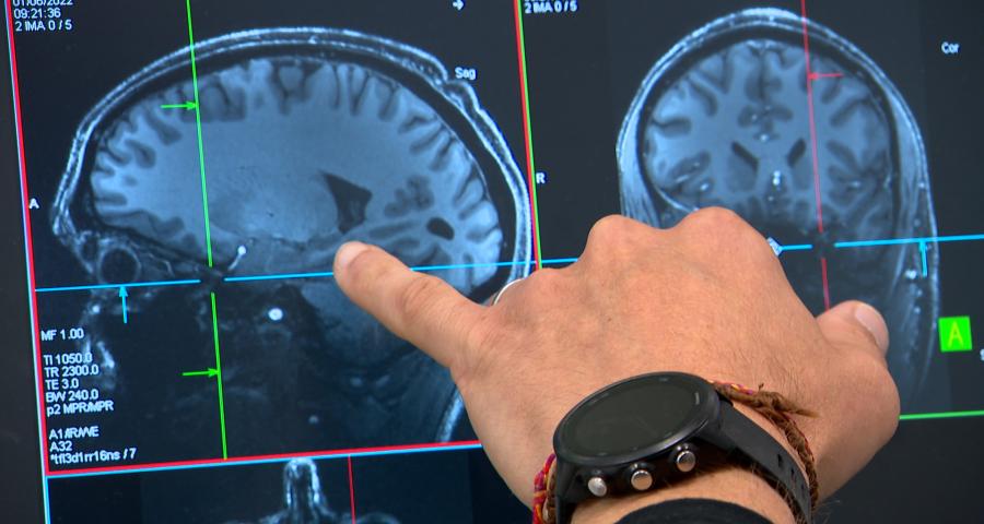 Le sommeil et ses micro-réveils influencent la maladie d'alzheimer